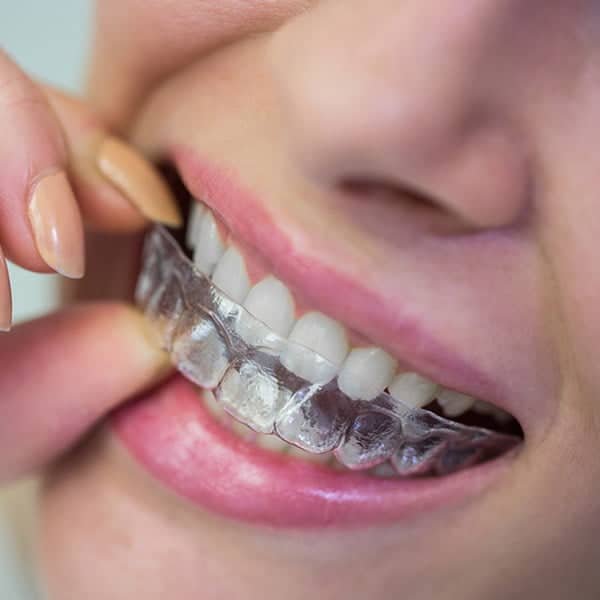 SG 牙齿矫正推荐